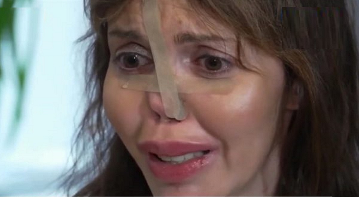 Стала неузнаваемой: как выглядит Алиса Аршавина, которой сделали новый нос