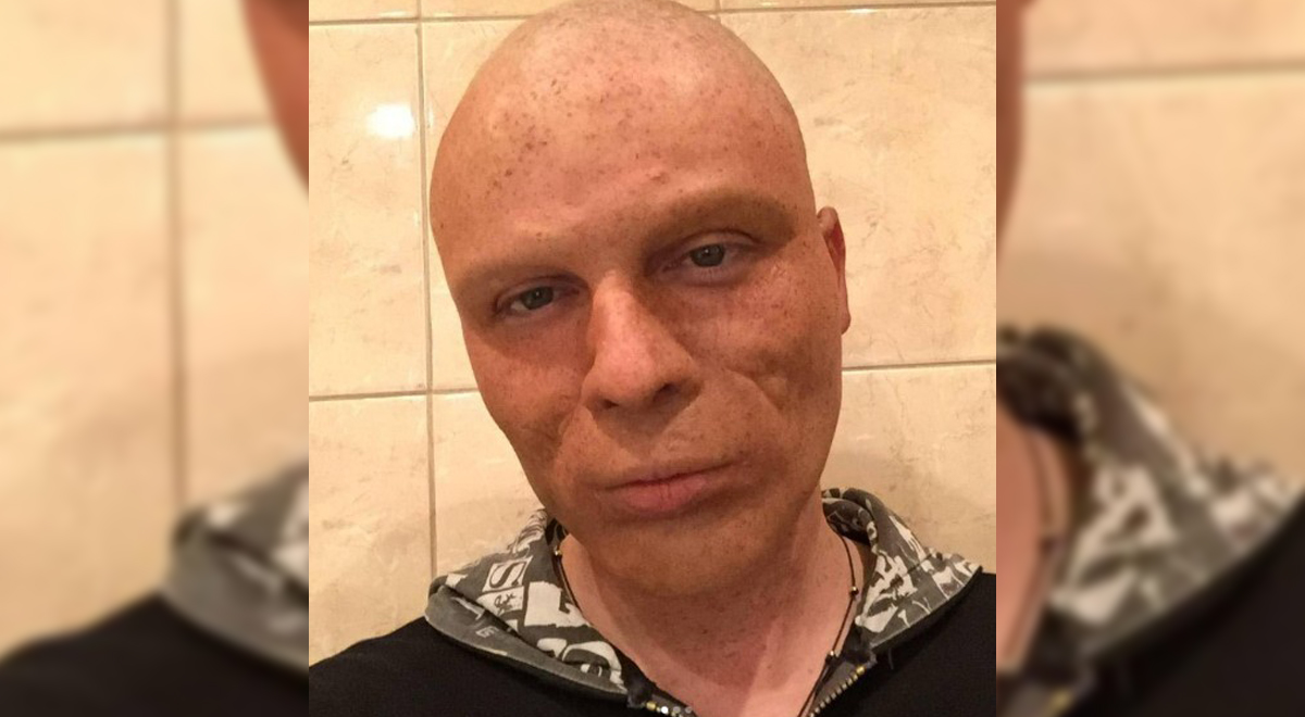 Лицо усыпано шрамами: Родион Газманов остался без волос и бровей